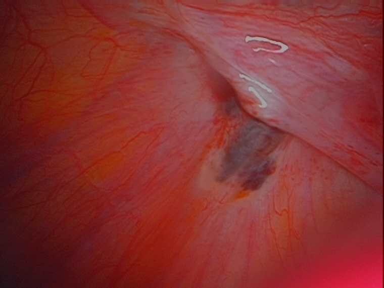 endometriosis nodule left side of pelvis serag youssif